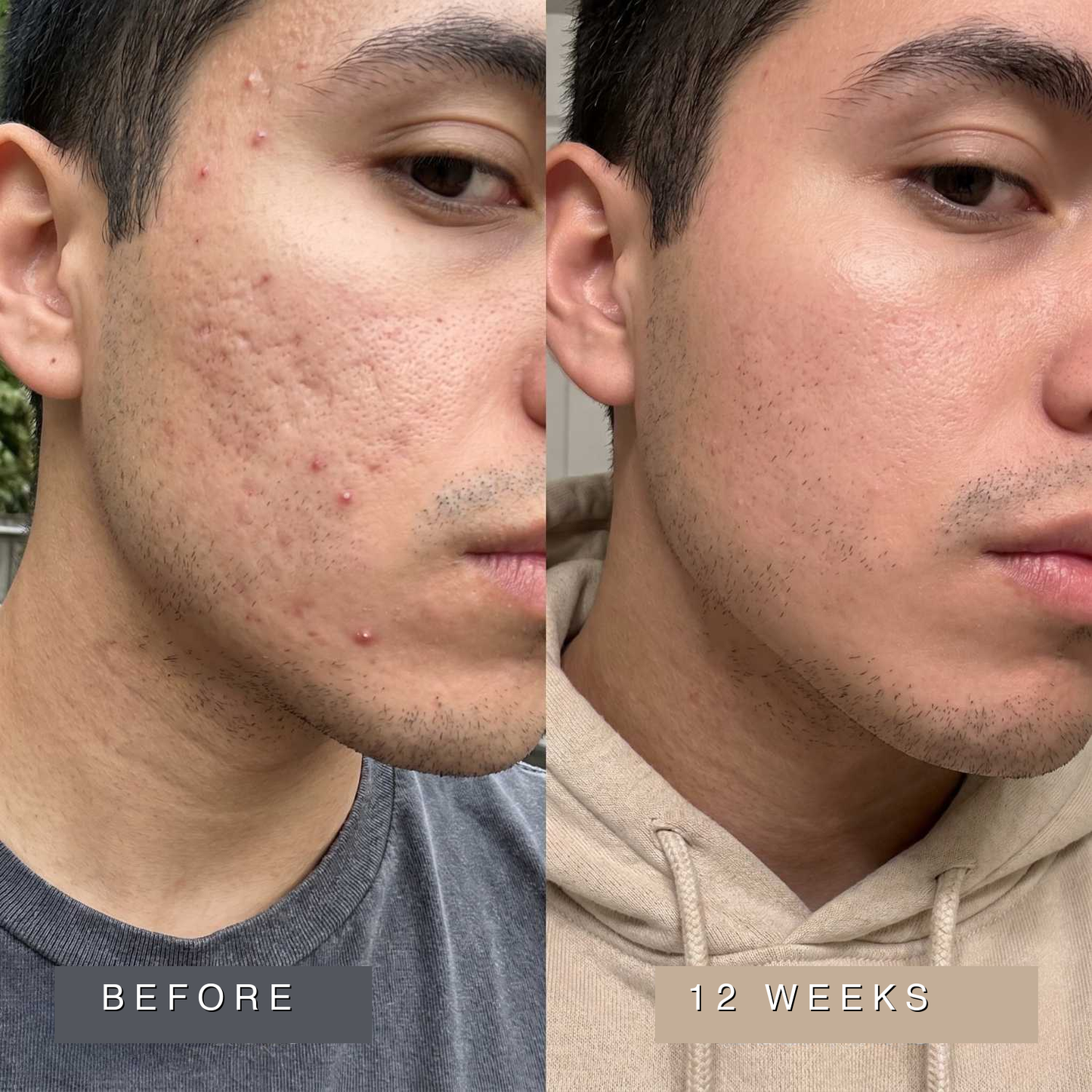 Acne Scar Remodeling Stick