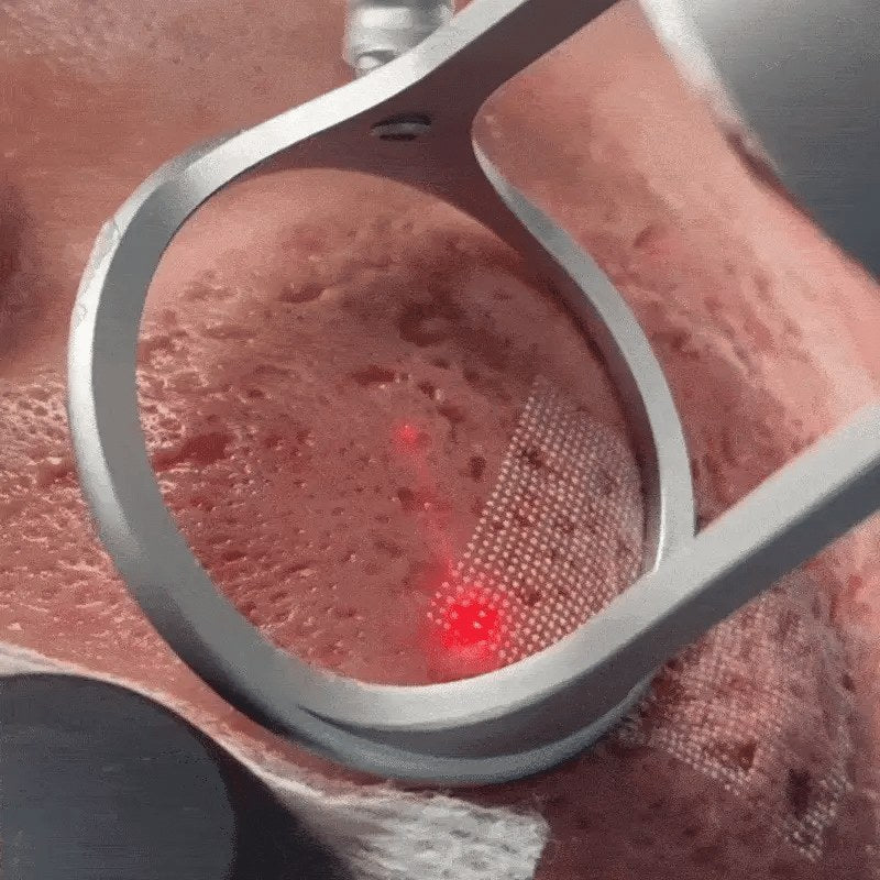 Laser treatment on scarred skin